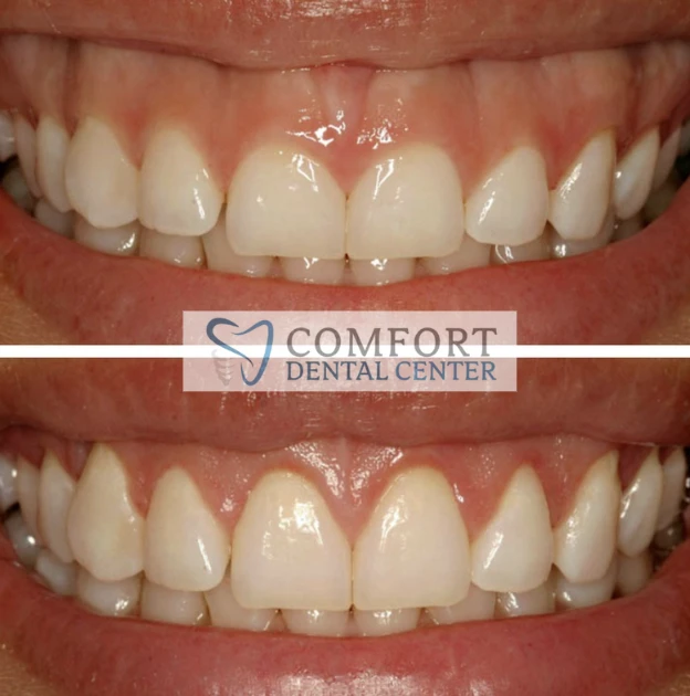 gummy-smile-showcase gallery